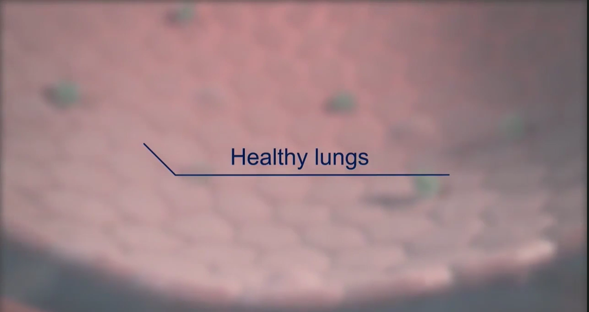 /my/inflammation/nintedanib/mechanism-action/approved-anti-fibrotic-known-and-established-mechanism