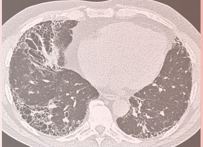 /sg/inflammation/nintedanib/about-pulmonary-fibrosis/listen-our-experts-explain-importance-proactive-monitoring-patients-ild