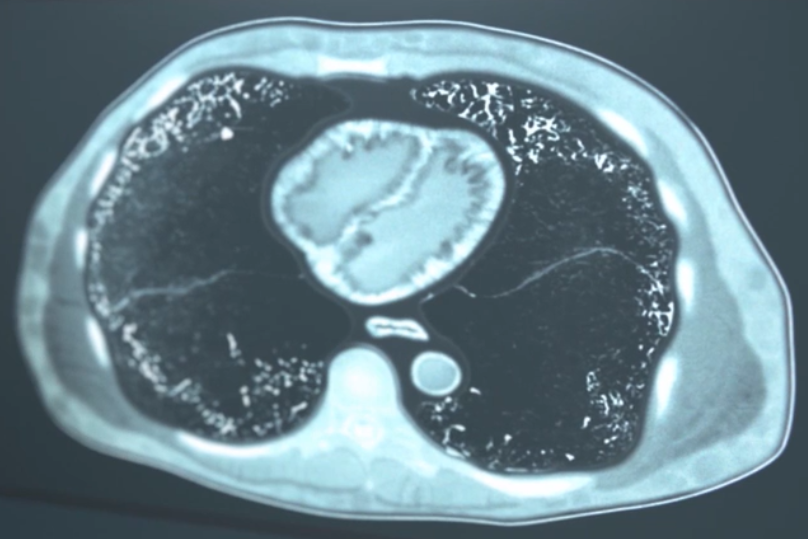 /sg/inflammation/nintedanib/about-pulmonary-fibrosis/discover-common-link-interstitial-lung-diseases