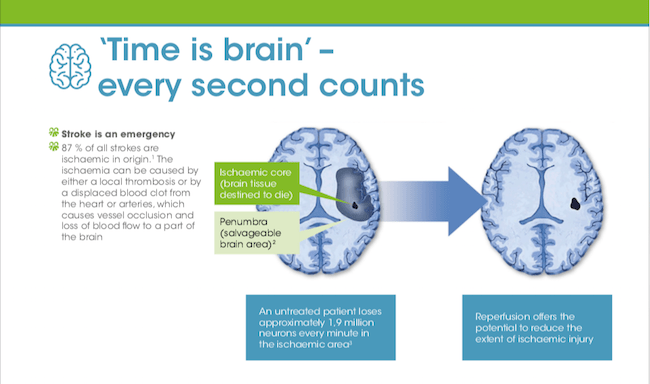 The importance of treating stroke as an emergency