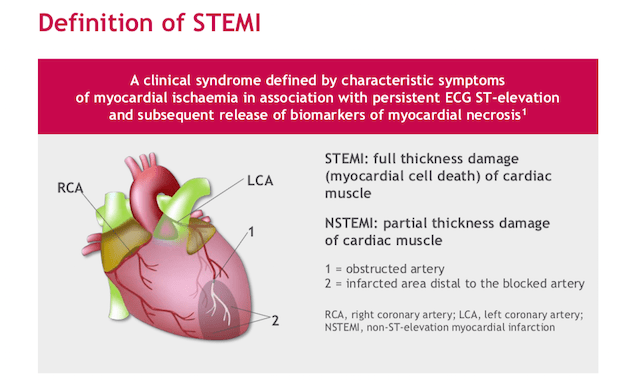 STEMI definition 